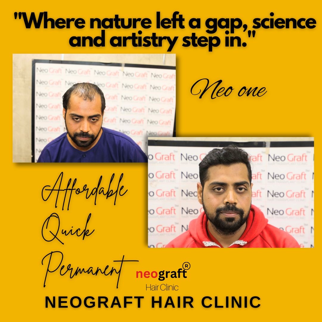 Hair transplant isn’t just about adding hair, it’s about restoring confidence.
